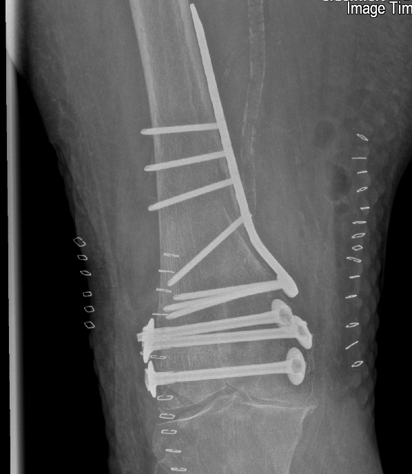 Isolated Fracture Of The Medial Femoral Condyle